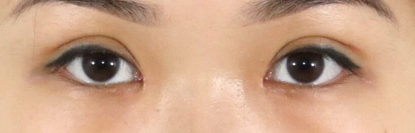 Asian Eyelid Surgery After