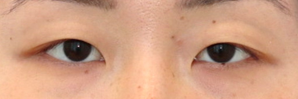 Asian Eyelid Surgery Before