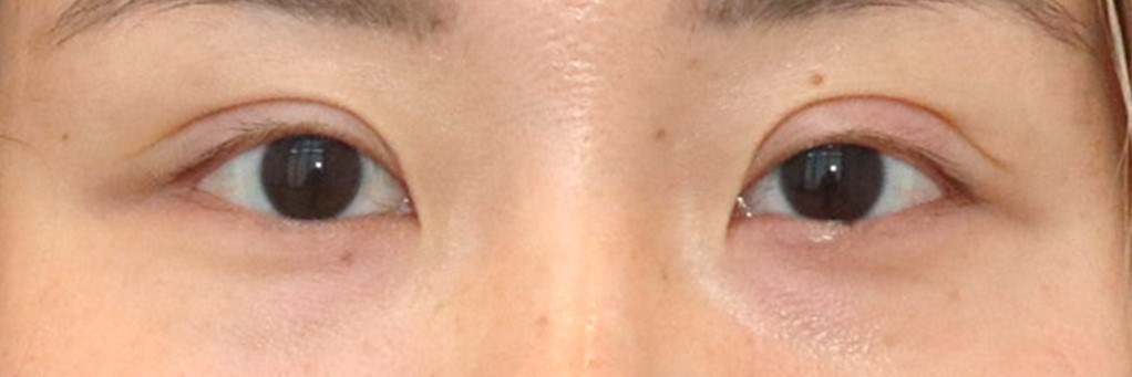 Asian Eyelid Surgery After