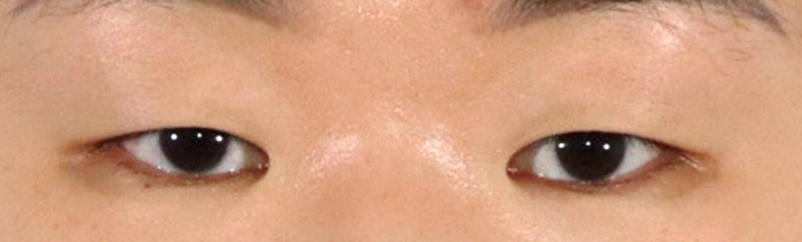 Asian Eyelid Surgery Before