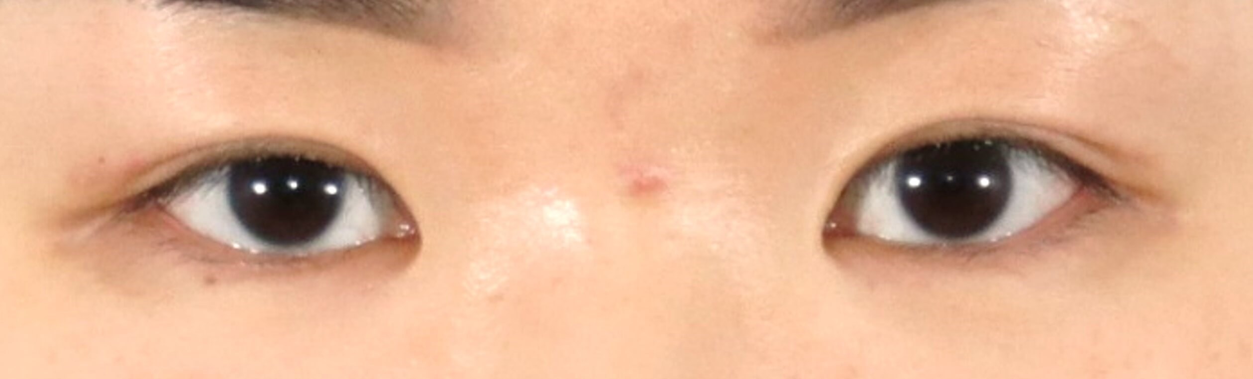 Asian Eyelid Surgery After