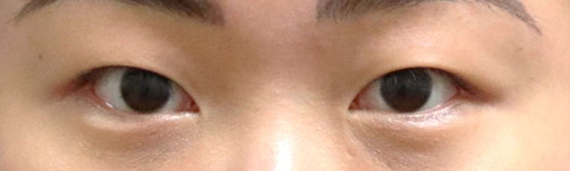 Asian Eyelid Surgery Before