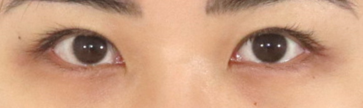 Asian Eyelid Surgery After