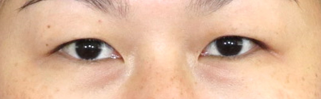 Asian Eyelid Surgery Before