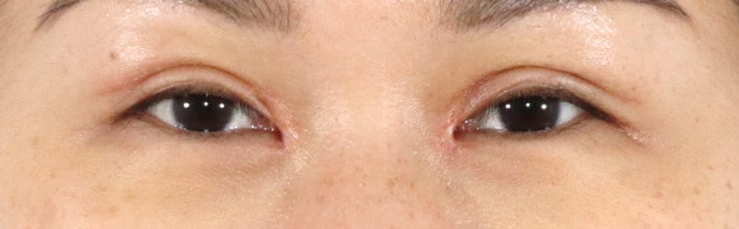 Asian Eyelid Surgery After