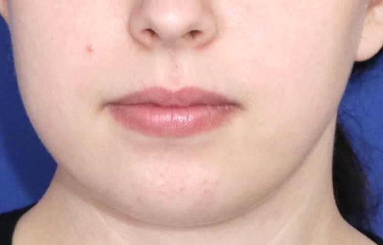 Before Image