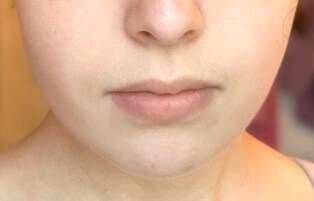 Buccal Fat Removal After