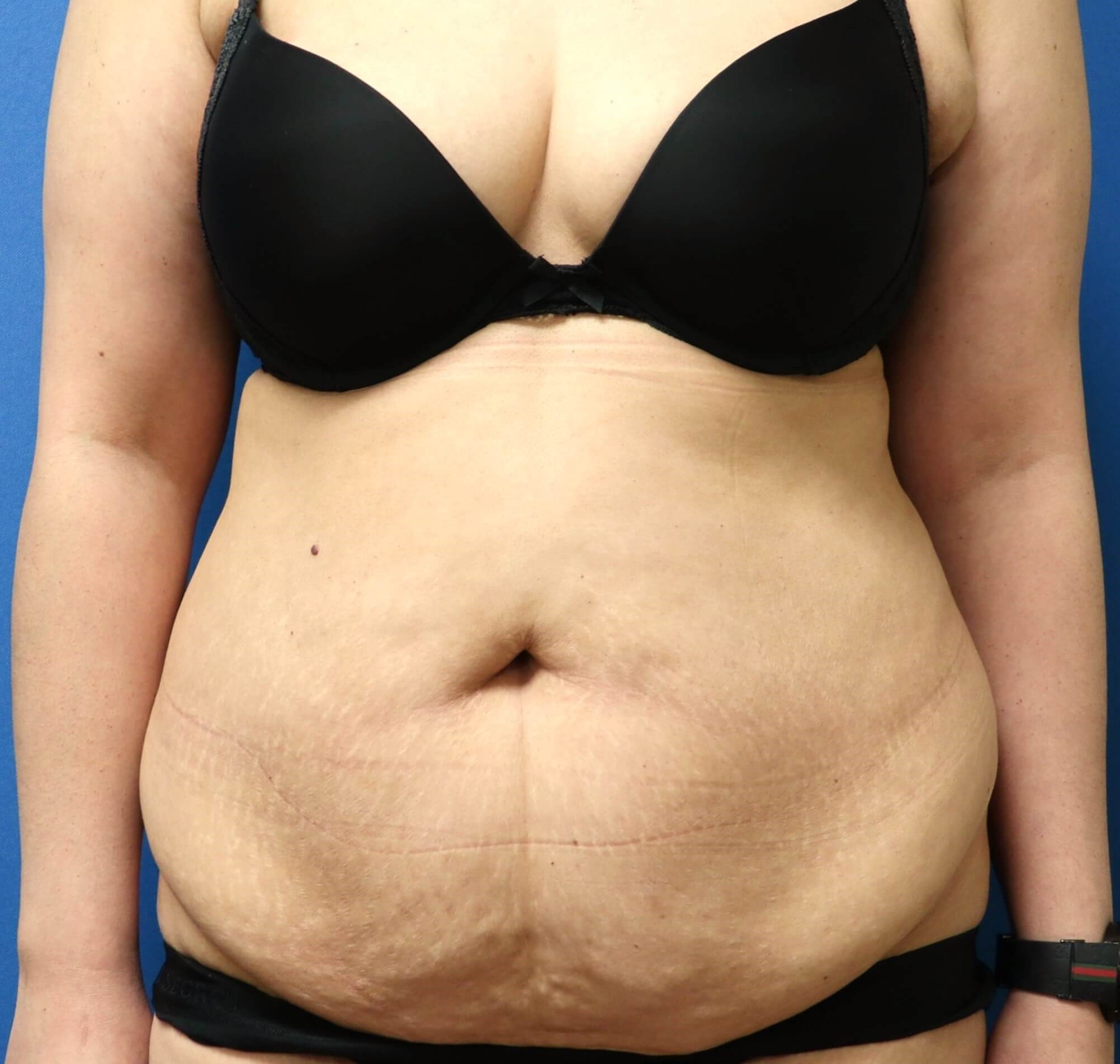 Abdominoplasty Surgery Before