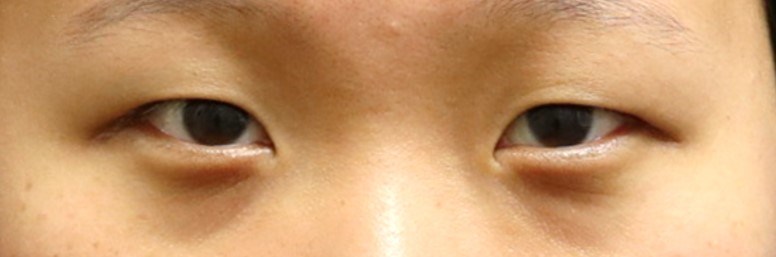 Asian Eyelid Surgery Before
