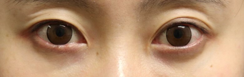 Asian Eyelid Surgery Before