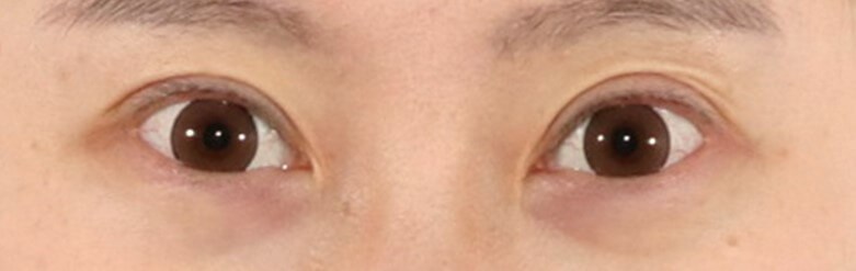 Asian Eyelid Surgery After