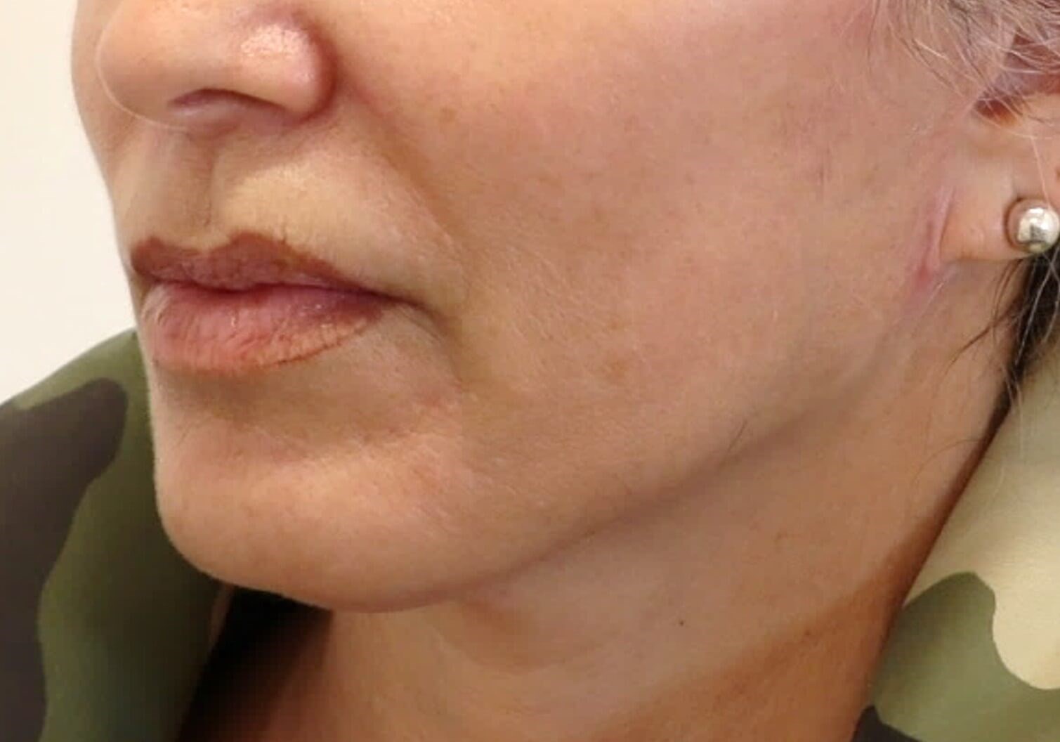 Facelift Surgery After