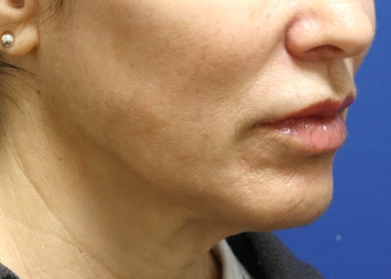 Facelift Surgery Before