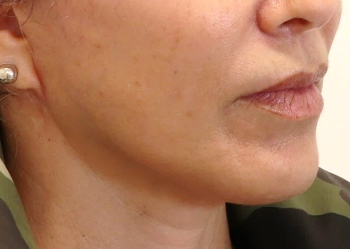 Facelift Surgery After