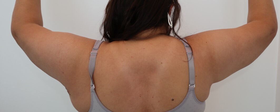 Brachioplasty and Liposuction After
