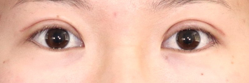 Asian Eyelid Surgery After