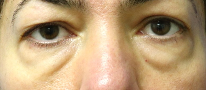 Lower Eyelid Surgery Before