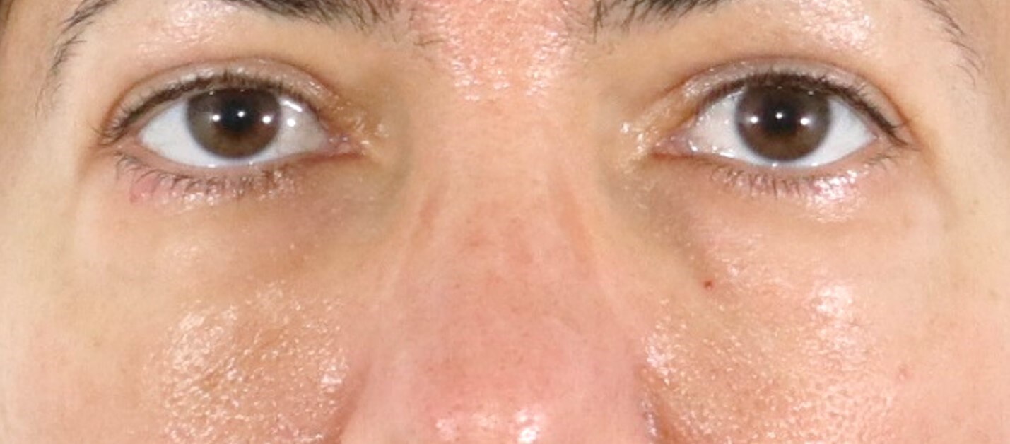 Lower Eyelid Surgery After