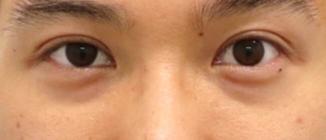 Asian Eyelid Surgery After
