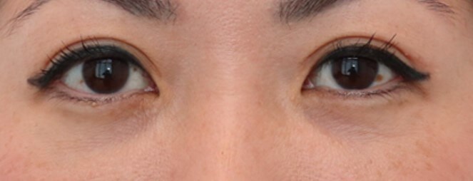 Fat Grafting Lower Eyelids After