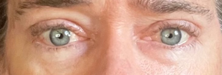 Upper Eyelid Surgery After