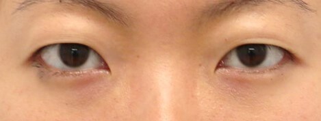 Asian Eyelid Surgery Before