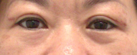 Upper Eyelid Surgery After