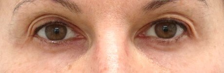 Upper Eyelid Surgery Before