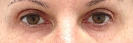 Upper Eyelid Surgery After