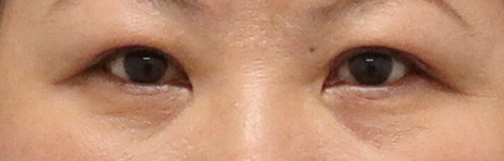 Asian Eyelid Surgery After