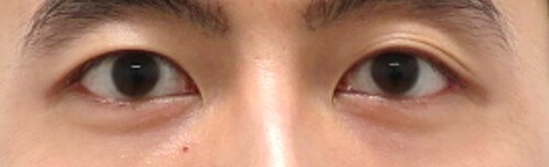 Asian Eyelid Surgery Before