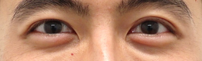Asian Eyelid Surgery After