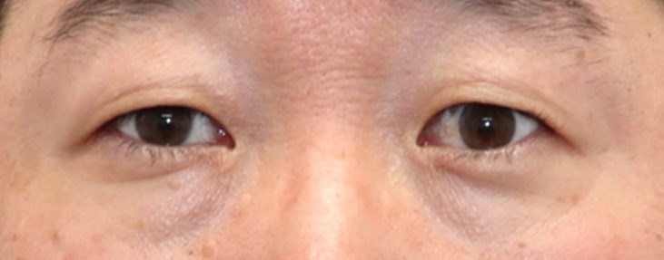 Asian Eyelid Surgery Before