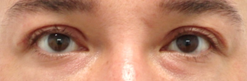 Upper Eyelid Surgery After