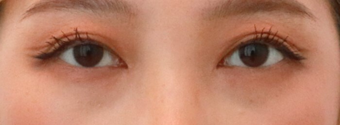 Asian Eyelid Surgery After