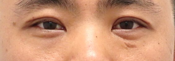 Asian Eyelid Surgery After
