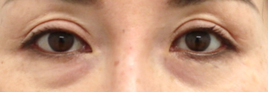 Upper Eyelid Surgery After