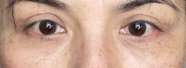 Upper Eyelid Surgery After
