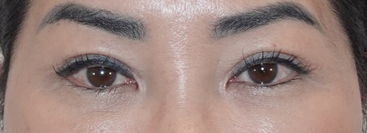 Upper Eyelid Surgery After