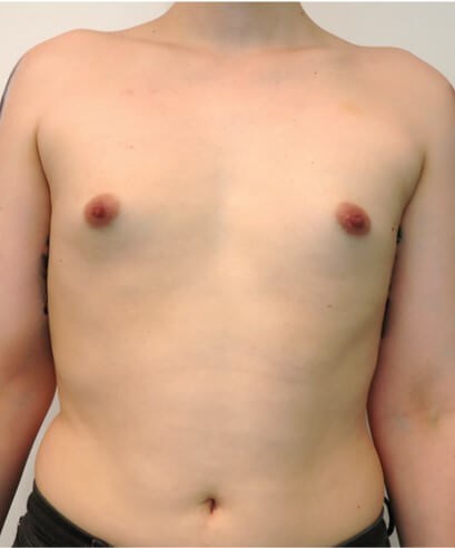 Breast Augmentation Before