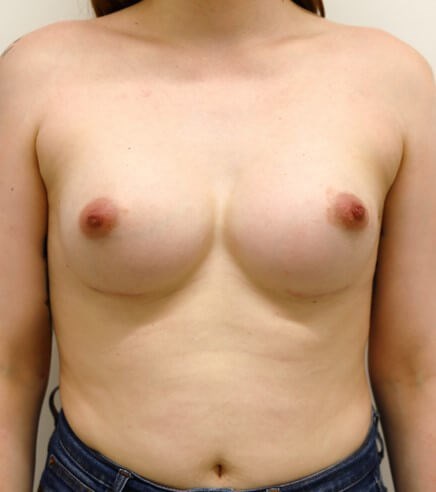 Breast Augmentation After