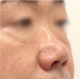 Rhinoplasty Surgery Before
