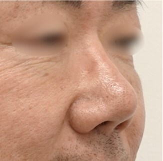 Rhinoplasty Surgery After