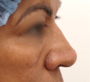 Rhinoplasty Surgery Before