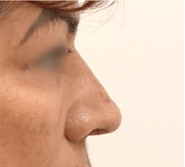 Rhinoplasty Surgery After
