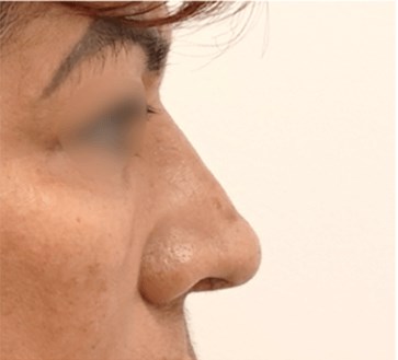 Rhinoplasty Surgery After