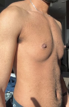 Mastectomy Before