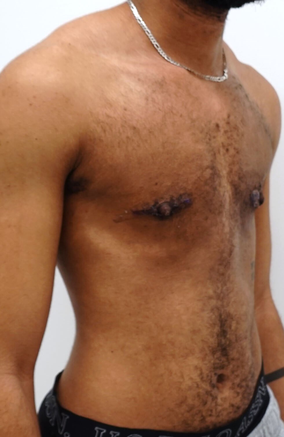 Mastectomy After