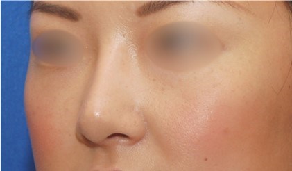 Rhinoplasty Surgery After