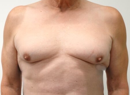 Breast Augmentation Before